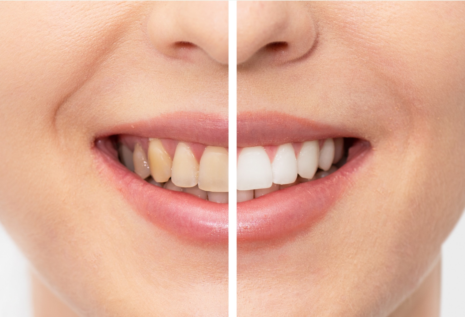 Teeth whitening transformation